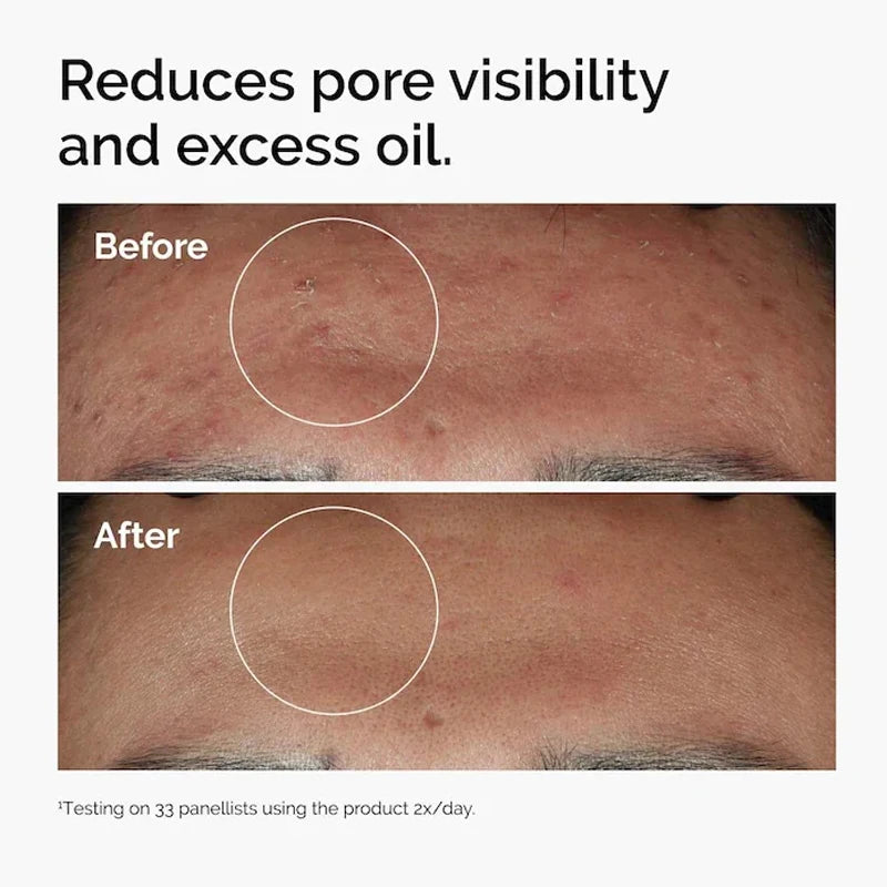 Niacinamide 10% + Zinc 1% Serum — Minimize Pores & Balance Skin (30ml)